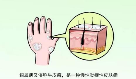 牛皮癣患者如何过夏天