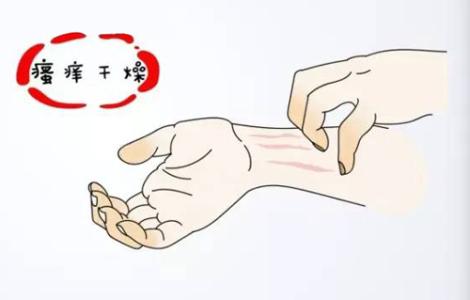 牛皮癣瘙痒能抓吗