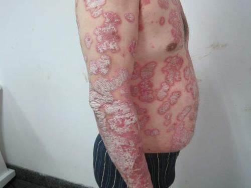 牛皮癣如何治疗