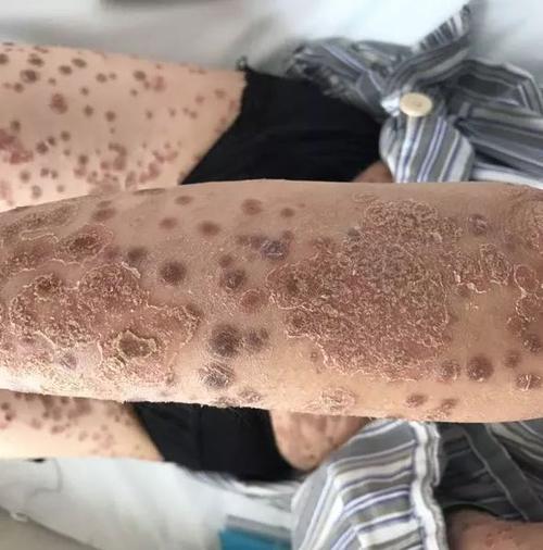 牛皮癣需要如何护理