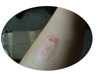 牛皮鲜如何治疗