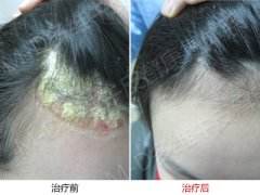 患上头部牛皮癣咋办