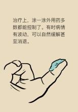 牛皮癣患者可以长期的使用外用药吗
