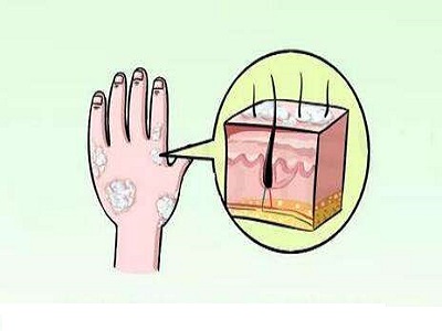 牛皮癣病情为啥加重