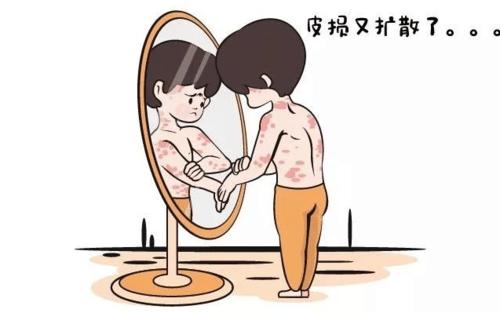 如何预防牛皮癣