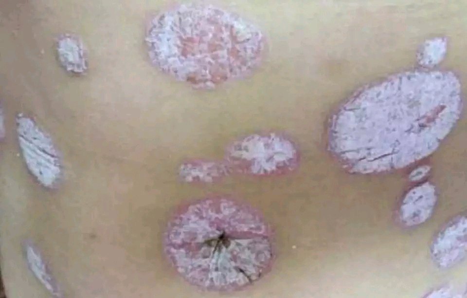 牛皮癣初期怎么控制