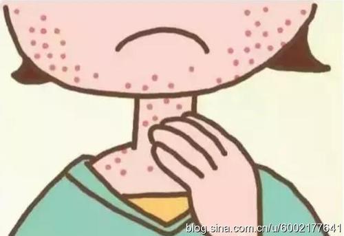 牛皮癣的危害都有哪些