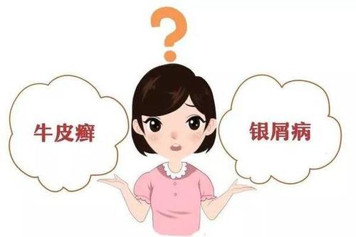 治疗牛皮癣犯的错