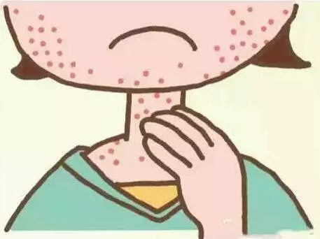 牛皮癣瘙痒咋办