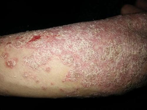 银屑病患者的生活如何