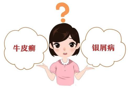 银屑病,副银屑病如何正确辨别