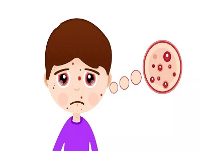 面部牛皮癣如何护理