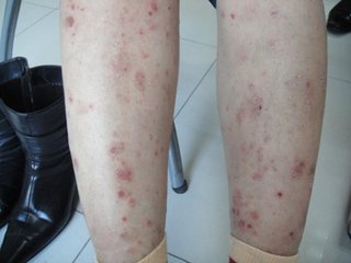 重视牛皮癣的发病