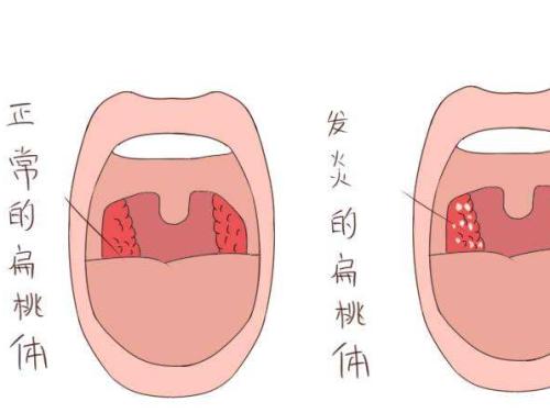 抵御牛皮癣反复发作措施