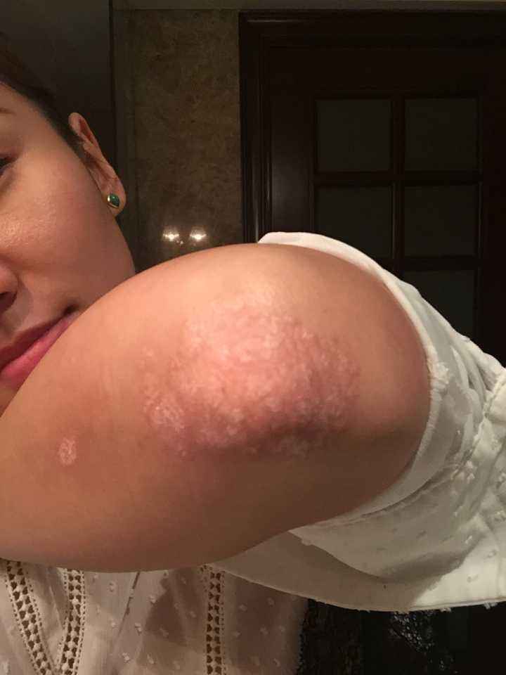 重视牛皮鲜的治疗