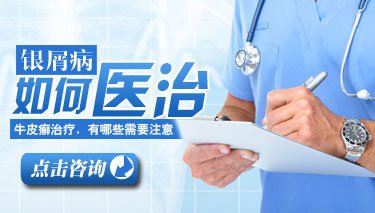 得了牛皮癣能治得好吗