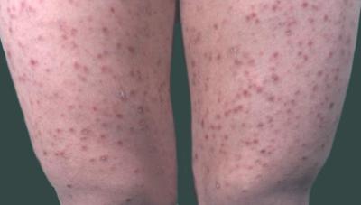 牛皮癣治疗陷阱