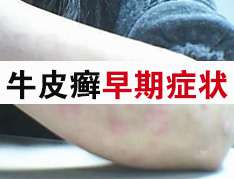 温变化牛皮癣患者如何应对