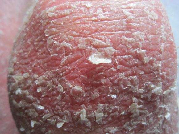 银屑病患者的皮肤干燥