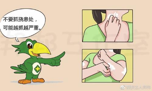 银屑病流脓咋办