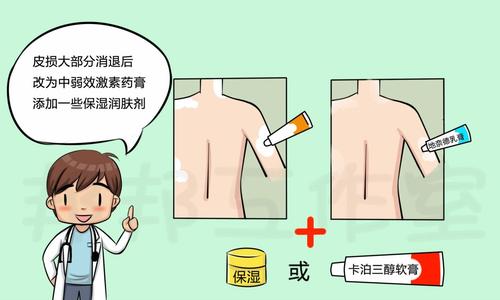 哪些衣服牛皮癣不能穿