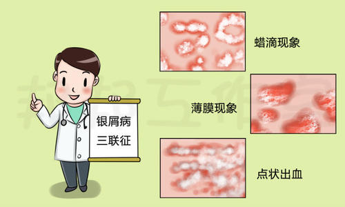 如何治疗牛皮癣不复发