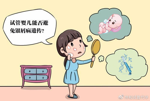 治疗好牛皮癣要花多少钱