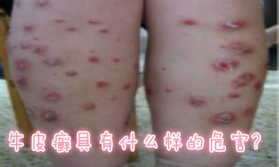 银屑病易造成哪些危害