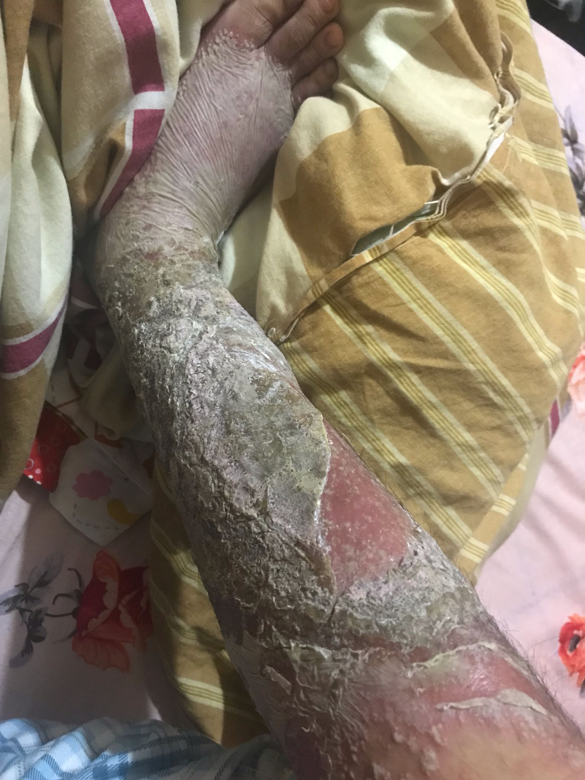 得了牛皮癣之后吃啥