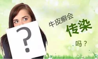 牛皮癣会不会传染