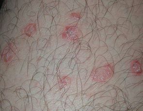 牛皮癣患者在如何应对瘙痒