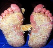 牛皮癣患者的鳞屑为啥增多