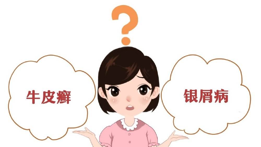 广州中医院治疗银屑病